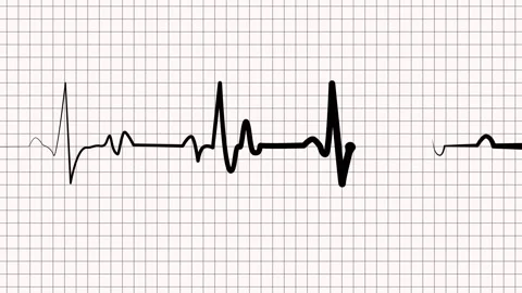 Ecg heartbeat line irregular pulse pattern medical background animation Stock Footage 336905696
