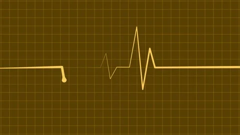 Ecg heartbeat line sharp pulse spike showing a medical monitor trace and a .. Stock Footage 337181740