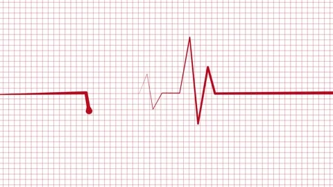 Ecg heartbeat line sharp pulse spike showing a medical monitor trace and a .. Stock Footage 337182619