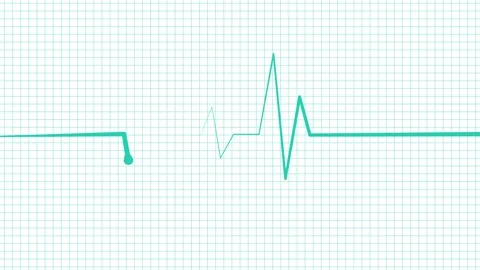 Ecg heartbeat line sharp pulse spike showing a medical monitor trace and a .. Stock Footage 337182632