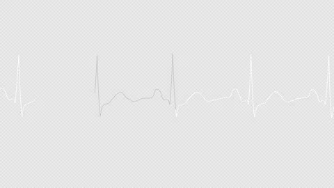 ECG looping.PNG Alpha.Normal Sinus Rhythm. Video stock 137796953