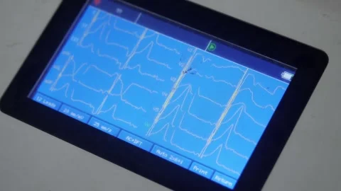 ECG machine display indicating pulse rate and heart condition of the patient Stock Footage 295790612