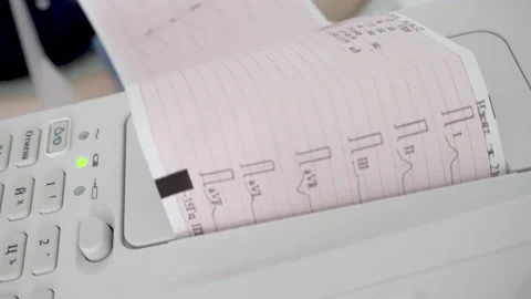 ECG machine printing electrocardiogram diagnostic results. Close-up of ECG, EKG Stock Footage 131290268