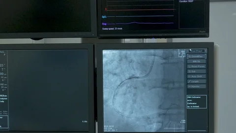 ECG monitors that stand in the operating room. On them the surgeon controls the Video stock 95230732