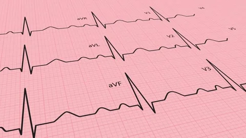 ECG multi lead heartbeat lines moving forward loop animation on medical grid. Vídeos de archivo 331791889