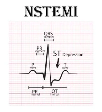 ECG of non ST elevation myocardial infarction (NSTEMI) and detail of ECG ( P Stock Illustration