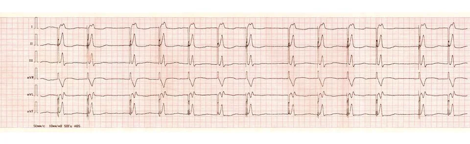 ECG with pacemaker arrhythmia (ventricular stimulation) Stock Photos