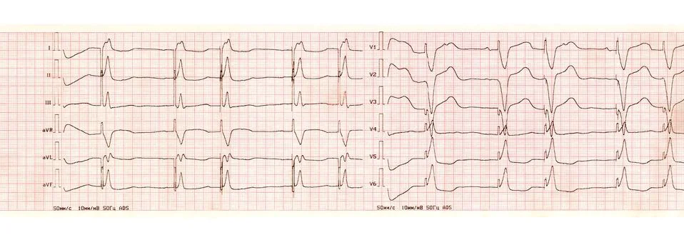ECG with pacemaker arrhythmia (ventricular stimulation) Stock Photos