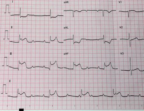 ECG print out 스톡 사진