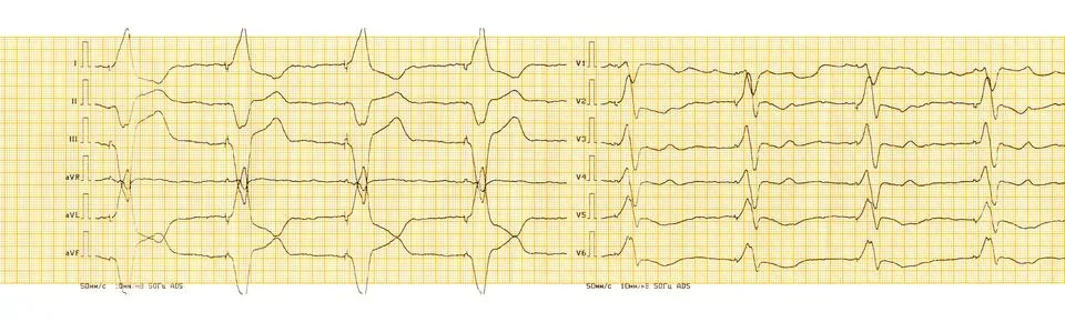 ECG with rhythm of artificial pacemaker (ventricular stimulation) Stock Photos