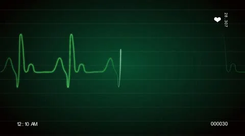 ECG Screen Stock-Footage 11425222