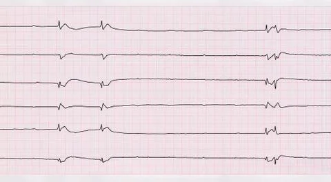 ECG with single ventricular complexes and ventricular asystole ("dying heart" Stock Photos