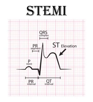 ECG of ST elevation myocardial infarction ( STEMI ) and detail of ECG ( P wav Stock Illustration