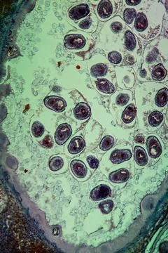 Echinococcus Parasiten in infizierter Leber Echinococcus Parasiten in infi... Stock-Fotos