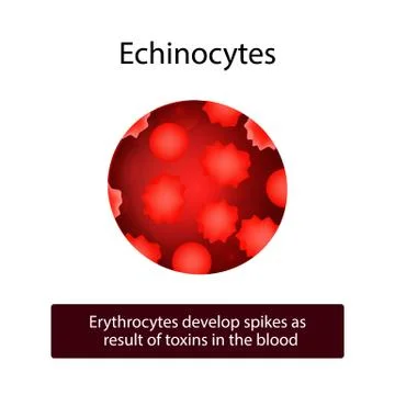 Echinocytes. Erythrocytes develop spikes as result of toxins in the blood Stock Illustration