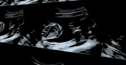 Echo-CMB34 Stock Footage 320966799