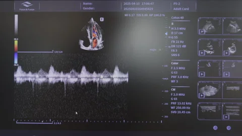 Echocardiogram screen with Doppler waveform and heart chamber scan, Cardiac Stock Footage 311075438