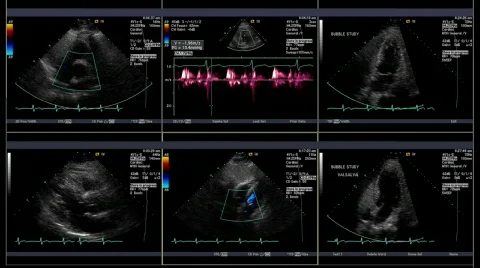 Echocardiogram test captured in six windows Stock Footage 290222