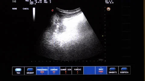 Echography Stock Footage 32454742