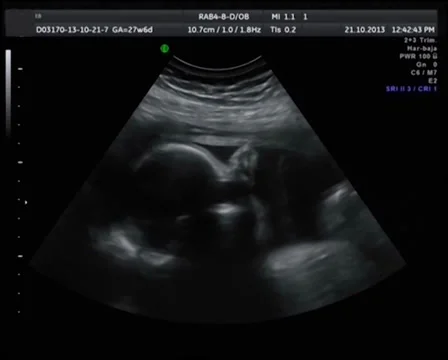 Echography the Ultrasound Stock Footage 37890896