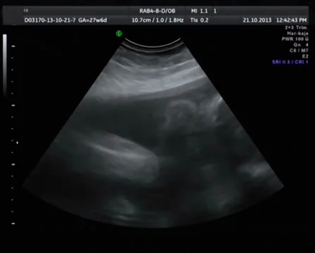 Echography the Ultrasound Stock Footage 37892280