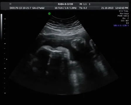 Echography the Ultrasound Stock Footage 37893598