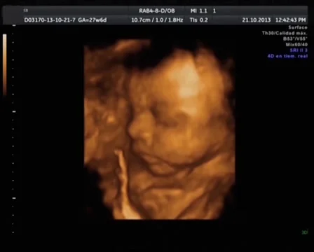 Echography the Ultrasound Stock Footage 37894944