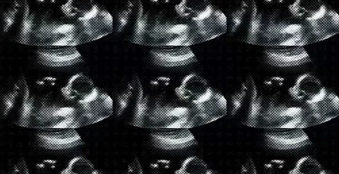 Echography Ultrasound Stock Footage 320965895