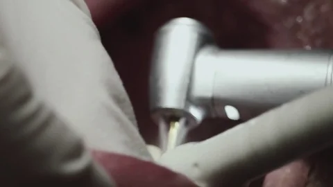 ECU dentist drill working on a patients mouth Stock Footage 74445861