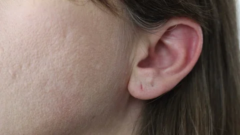 ECU of Vigorous Scratching of Ear and Scalp Vidéo 87030457