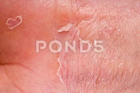 Eczema closeup Stock Photos