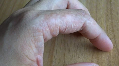 Eczema on Hands Atopic Dermatitis Stock Footage 240715718