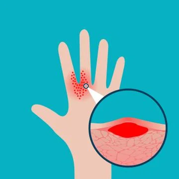 Eczema Stock Illustration