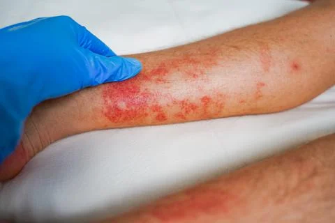 Eczema Skin disease on the legs, itchy red rashes and spots Stock Photos