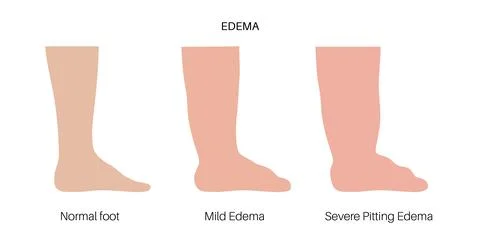 Edema of feet Stock Illustration