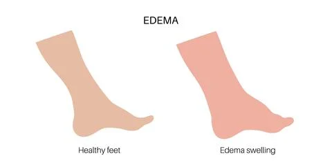 Edema of feet Stock Illustration