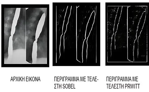 Edge Detection in Medical Imaging: Comparison of Sobel and Prewitt Operator.. Stock Photos