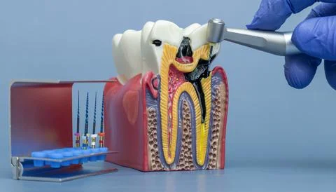 Educational anatomy model showing deep tooth decay and pulpitis. Dentist clea Stock Photos