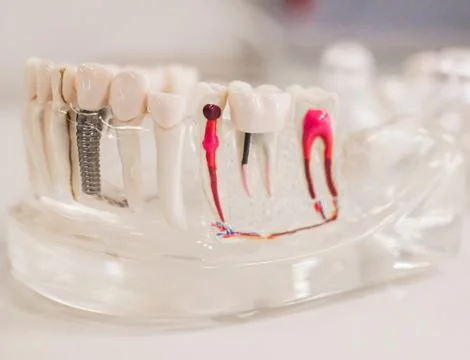 Educational model of human jaw with teeth and implants Stock Photos