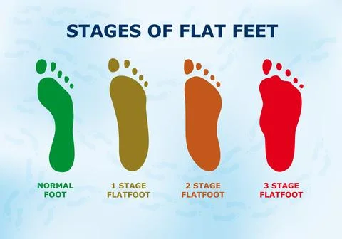 Educational poster about flat feet, different stages of the disease. Stock Illustration