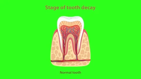 Educational video showing stage of tooth decay from normal tooth to advance.. Stock Footage 332688475
