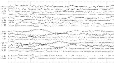 EEG of Drowsy Patient (Loopable) Stock Footage 61296949
