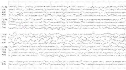 EEG of Elderly Patient (Loopable) Hospital Equipment real Stock Footage 61296980