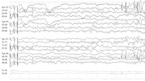 EEG of Epileptic Seizure 2 (Loopable) Stock Footage 61240481