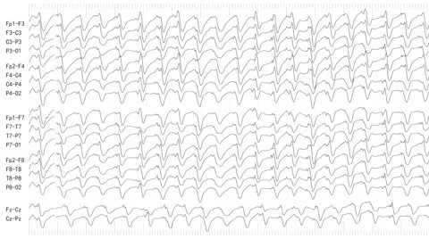 EEG of Epileptic Seizure (Loopable) Stock Footage