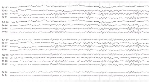 EEG of Patient With Dementia (Loopable) Stock Footage 61233651
