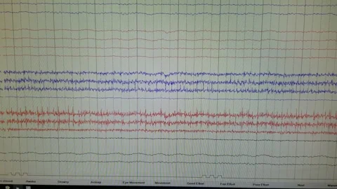 EEG Showing Brainwave Tracings from Multiple Leads Stock Footage 162706860