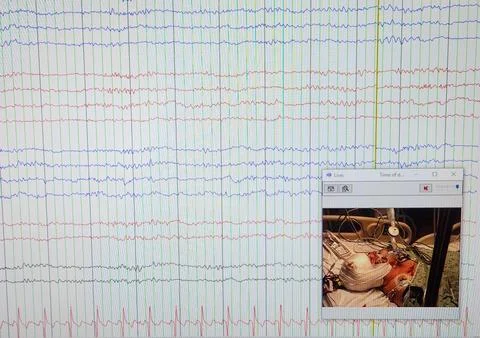 EEG Showing Diffuse Slowing on Multiple Leads Stock-Fotos