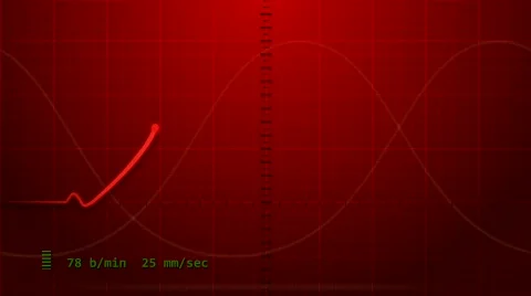EKG - Electrocardiogram Vídeo Stock 593402