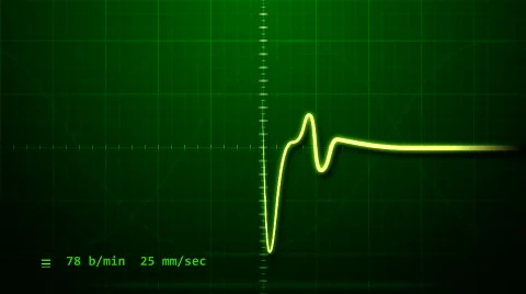 EKG - Electrocardiogram Stock Footage 599460